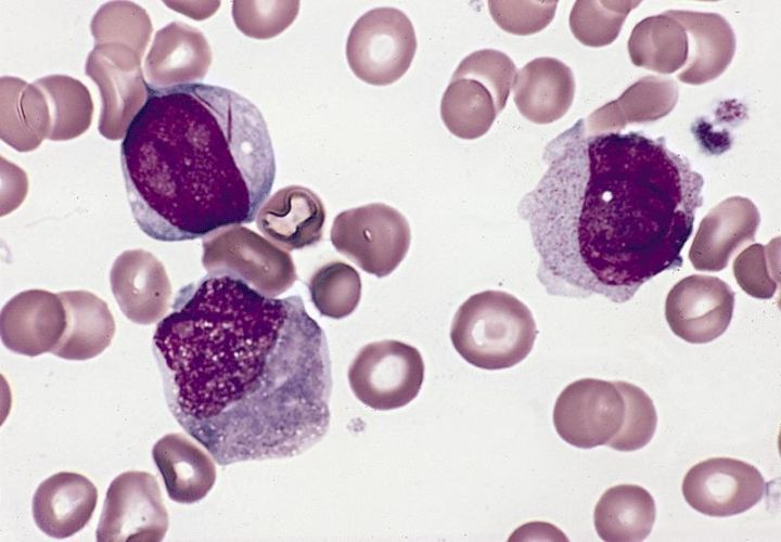 Pathology Outlines - Acute myelomonocytic leukemia (AMML)