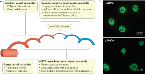 ANCA-associated vasculitis  Nature Reviews Disease Primers
