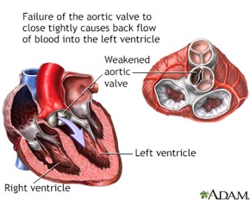 Aortic insufficiency Information  Mount Sinai - New York