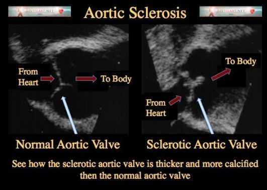 Aortic Sclerosis Diagnosis, Treatments, & Risk Factors