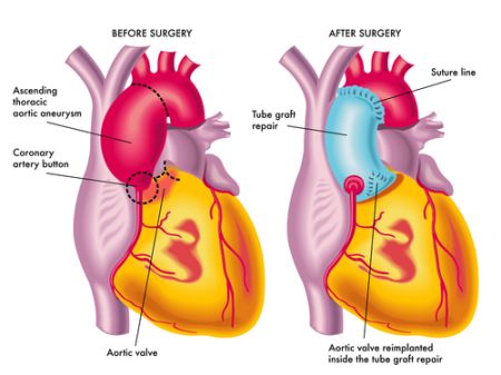 Ascending Aortic Aneurysm  Learn the Heart