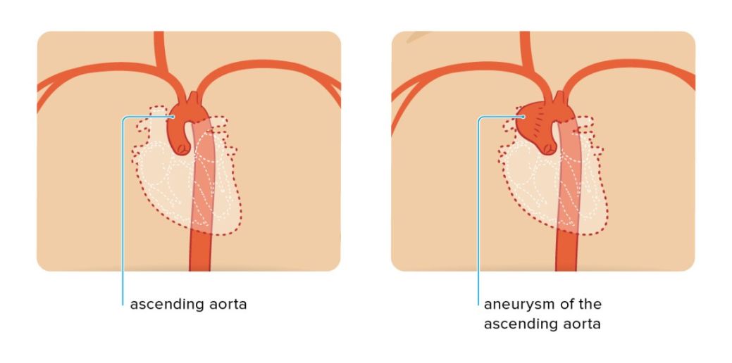 Ascending Aortic Aneurysm: Repair, Surgery, and Size Criteria