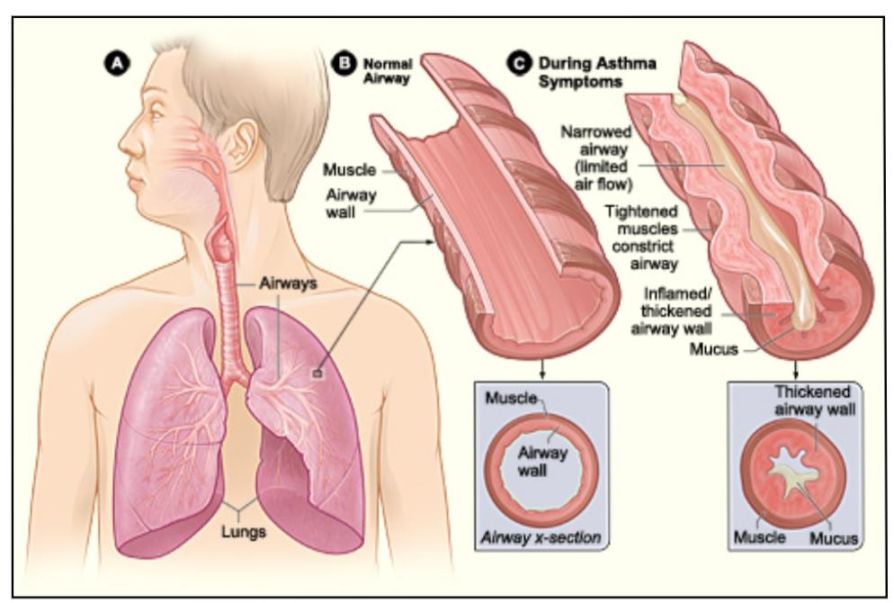Asthma ICD  - Coding Guidelines along with Examples