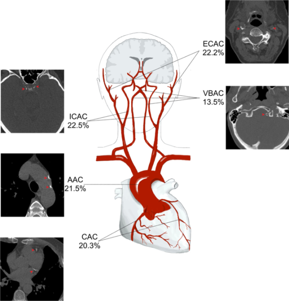 C-factor: a summary measure for systemic arterial calcifications