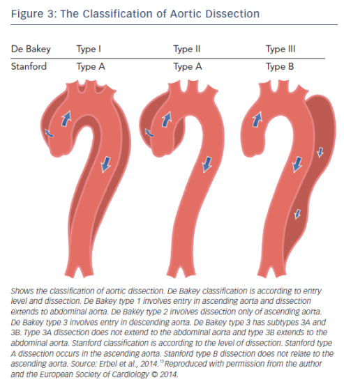 Cardiovascular Management of Adults with Marfan Syndrome  ECR Journal