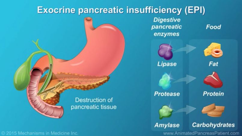 Causes of Pancreatic Insufficiency, Risk Factors, Symptoms, and