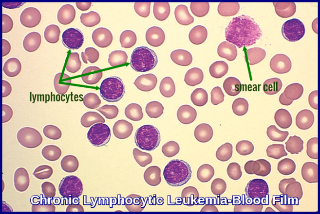 Chronic Lymphocytic Leukemia - Ask Hematologist  Understand