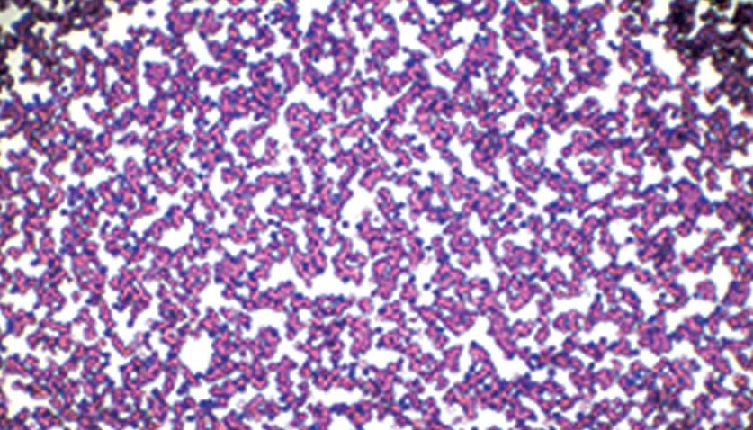 Cure What Ails Your Chronic Lymphocytic Leukemia Coding - AAPC