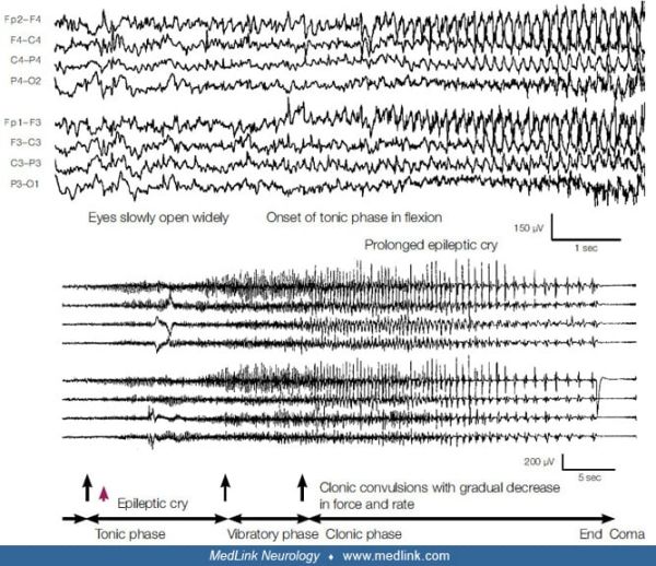 Epilepsy with generalized tonic-clonic seizures alone  MedLink