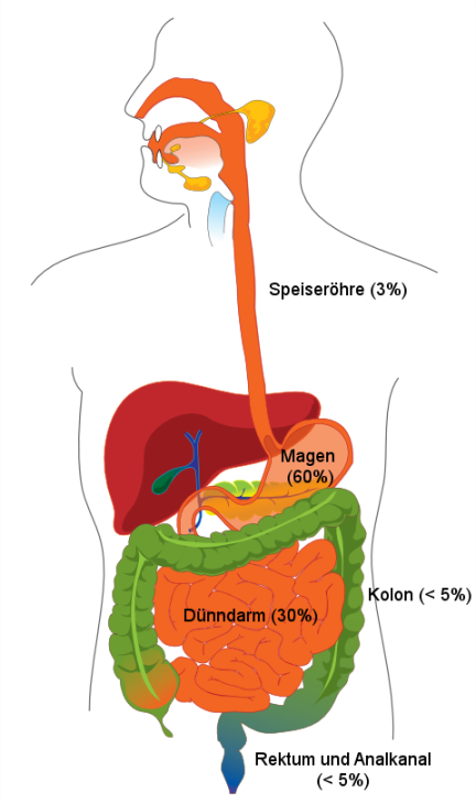 Gastrointestinaler Stromatumor – Wikipedia