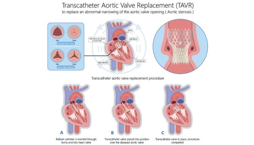 Get to the Heart of Coding TAVR - AAPC Knowledge Center
