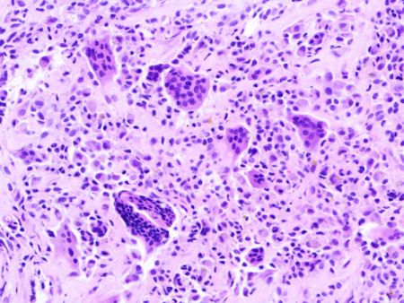 giant-cell tumor of the tendon sheath - Wikidata