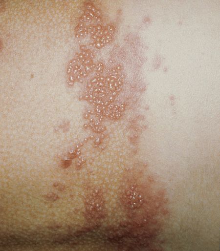 Herpes Zoster – Wikipedia