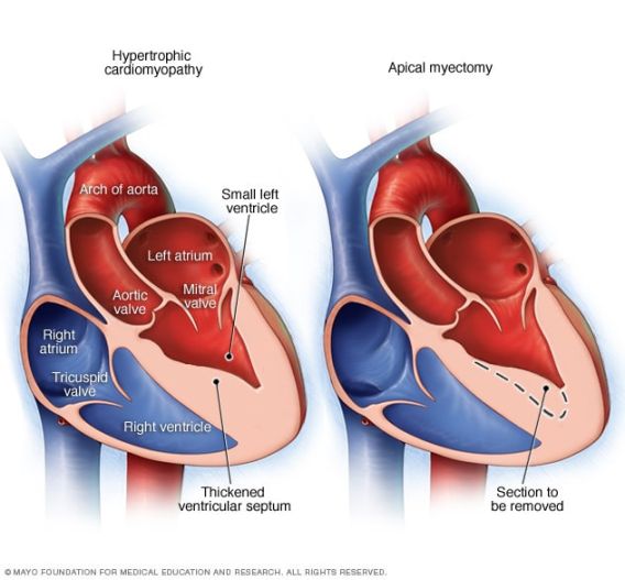 Hypertrophic cardiomyopathy - Diagnosis and treatment - Mayo Clinic