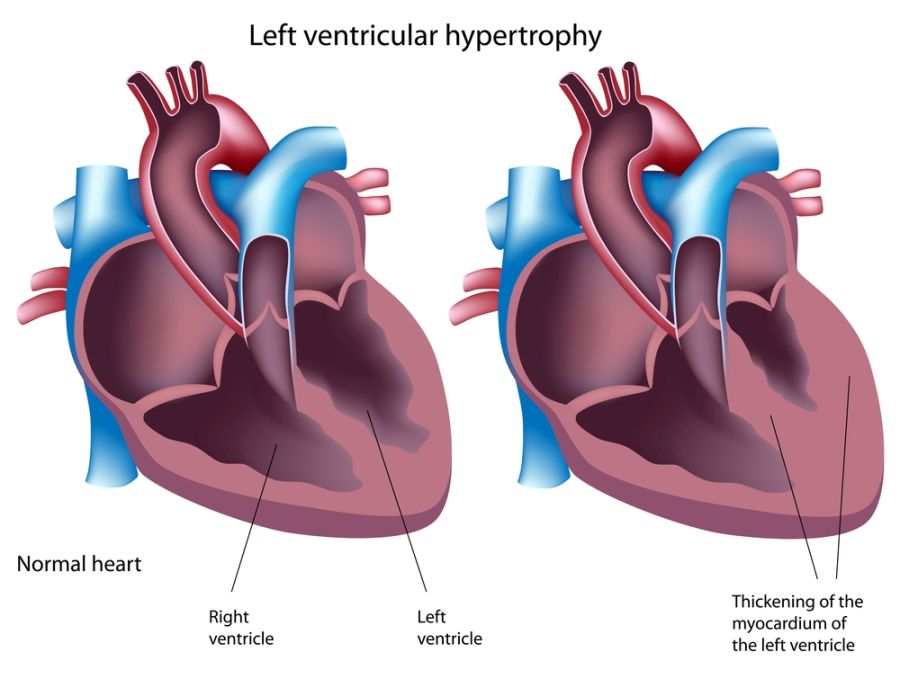 Hypertrophic Cardiomyopathy (HCM) - Australian Genetic Heart
