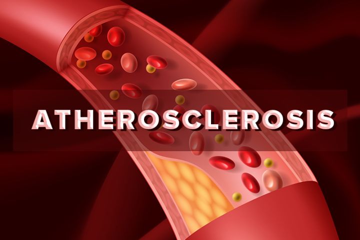 ICD- Codes for Atherosclerosis