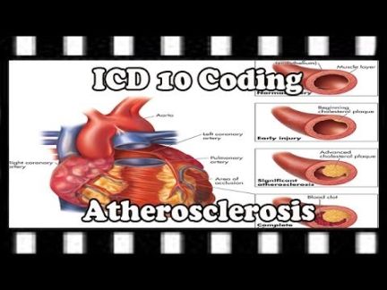ICD- Coding Tutorial: How to Code Atherosclerosis