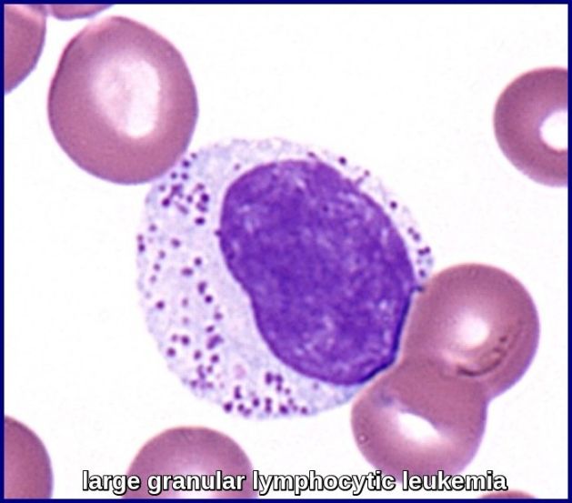 Large Granular Lymphocytic Leukemia - Ask Hematologist