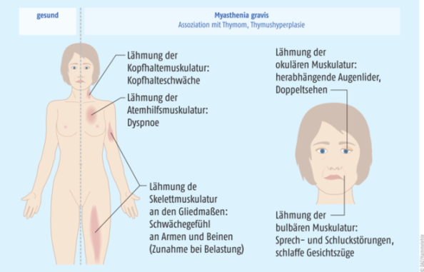 MEDIZIN: Myasthenia gravis: Doppelbilder und müde Muskeln