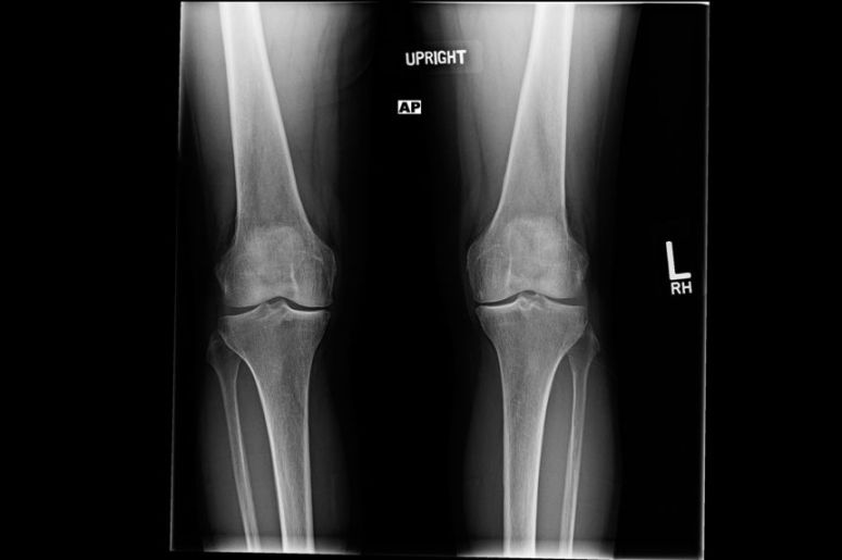 Ortho Dx: Bilateral Knee Pain Due to Osteoarthritis - Clinical Advisor