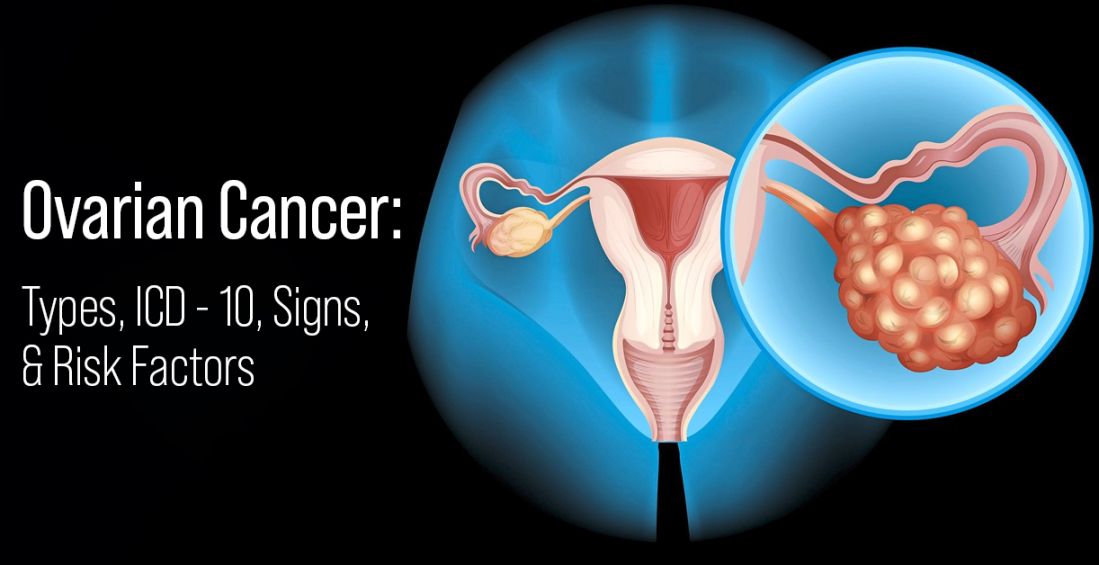 Ovarian Cancer: Types, ICD - , Signs, & Risk Factors