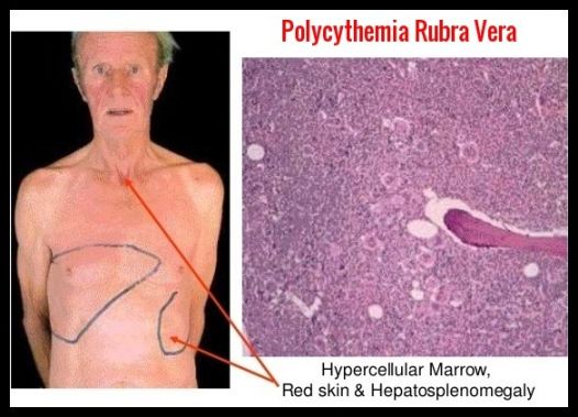 Polycythemia Rubra Vera - Ask Hematologist  Understand Hematology