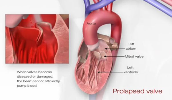 Problem: Mitral Valve Prolapse  American Heart Association