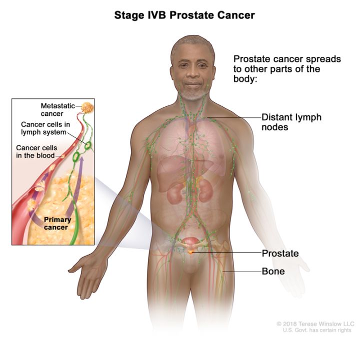 Stage  Prostate Cancer Diagnosis - XpertPatient