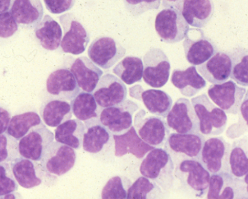 T-Cell Large Granular Leukemia (LGL)  Flow Cytometry