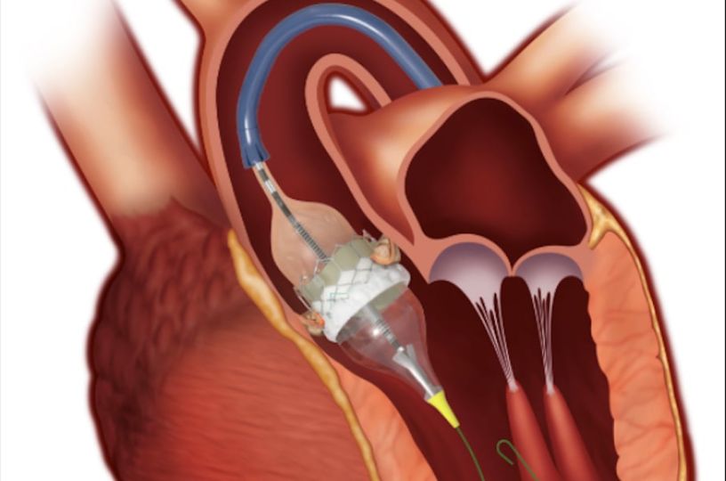 TAVR Is Now Dominant Form of Aortic Valve Replacement in the