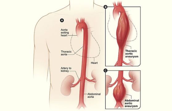 Thoracic aortic aneurysm - BHF