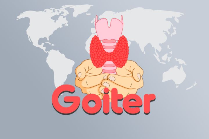 Understanding Goiter: Symptoms, Causes, and Diagnosis Codes