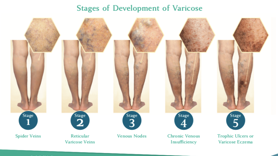 Venous Reflux Disease  Chronic Venous Insufficiency Stages
