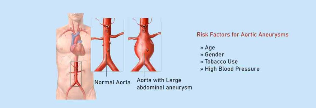 What Is an Aorta?  aortic aneurysm means