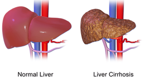 What is Liver Cirrhosis? symptoms, causes, diet and treatment.
