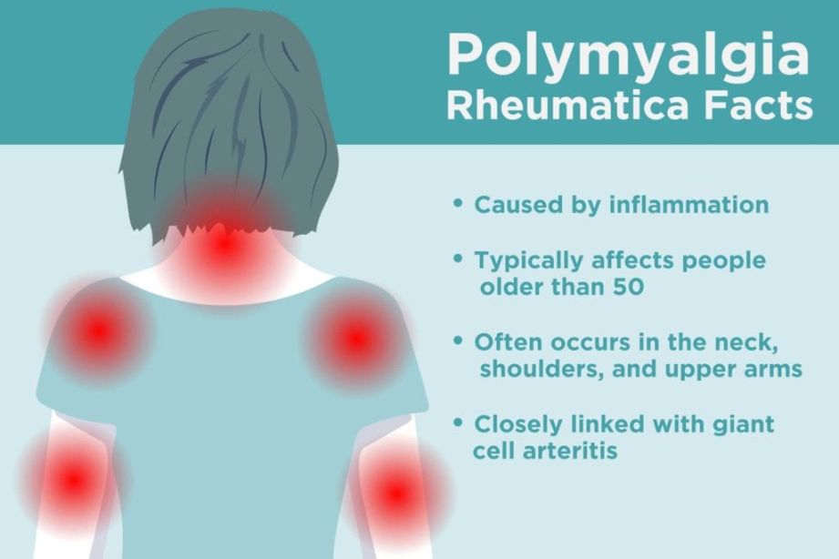 What is Polymyalgia Rheumatica? These Are the Signs You Could Have